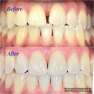 before and after Invisalign from Renton Smile Dentistry